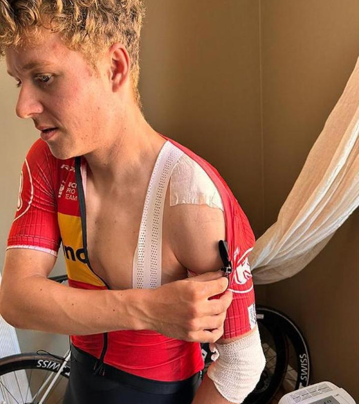 Ciclista fratura a clavícula há pouco mais de uma semana e é confirmado para o Tour de France, "como um menino de 12 anos", afirma o médico 3 girodociclismo.com.br apos fraturar a clavicula ha pouco mais de uma semana ciclista e confirmado para o tour de france como um menino de 12 anos afirma o medico image 2