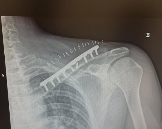 girodociclismo.com.br campeao canadense tem infeccao pulmonar confirmada e e duvida para o tour de france o ciclismo e um esporte cruel image