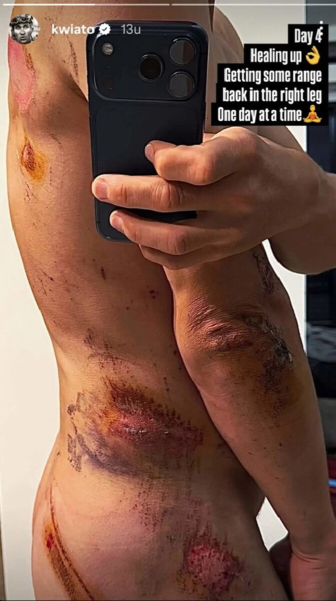 girodociclismo.com.br queda na milan san remo revela lesao mais grave de michal kwiatkowski e preocupa sequencia da temporada image 1