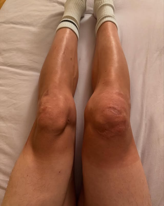 girodociclismo.com.br tom pidcock tem retorno incerto apos grave queda sem previsao estamos tentando drenar o liquido do joelho image